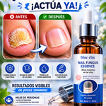 🤍 Nail Fungus Essence™ | Elimina los Hongos y Evita que Regresen